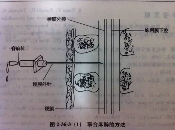 孕傻,剖腹产手术,腰麻