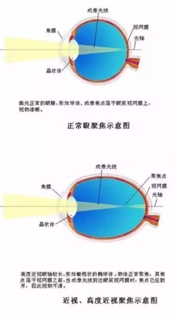 0-6岁预防近视关键期