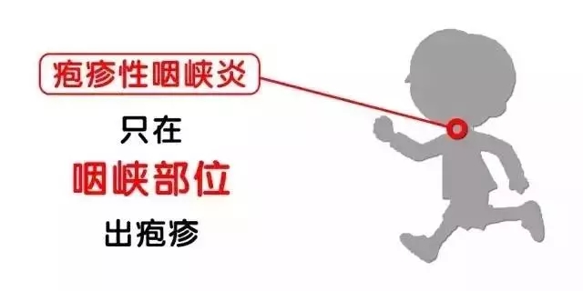 疱疹性咽峡炎