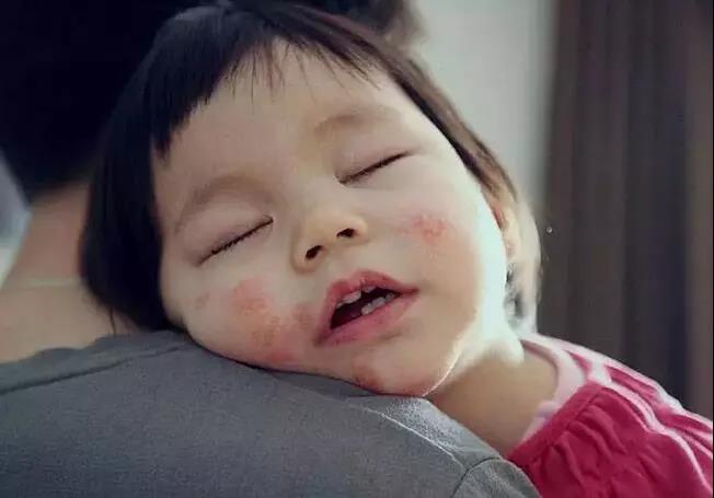 过敏